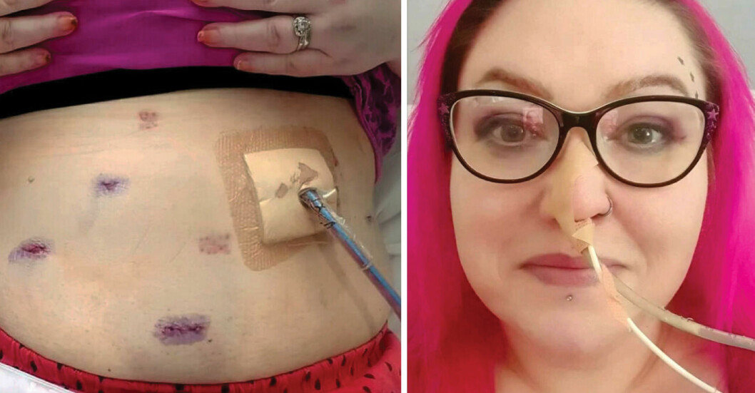 45-åringen vägde 110 kilo – la sig under kniven: ”Jag dog nästan”