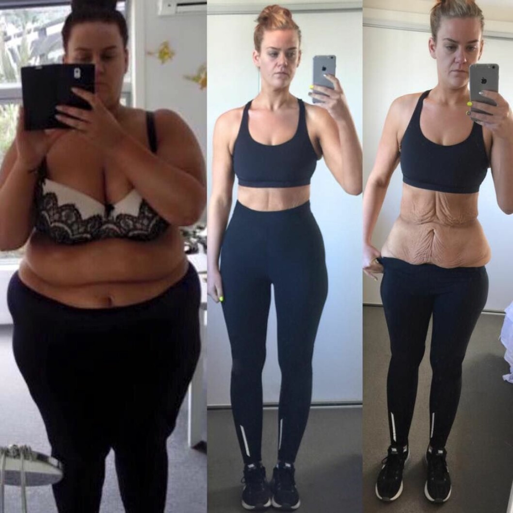 …så hon visade dem den osminkade sanningen. Foto: <a href="https://www.facebook.com/simonesjourneytohealth" target="_blank">Facebook</a> ...så hon visade dem den osminkade sanningen. Foto: Facebook