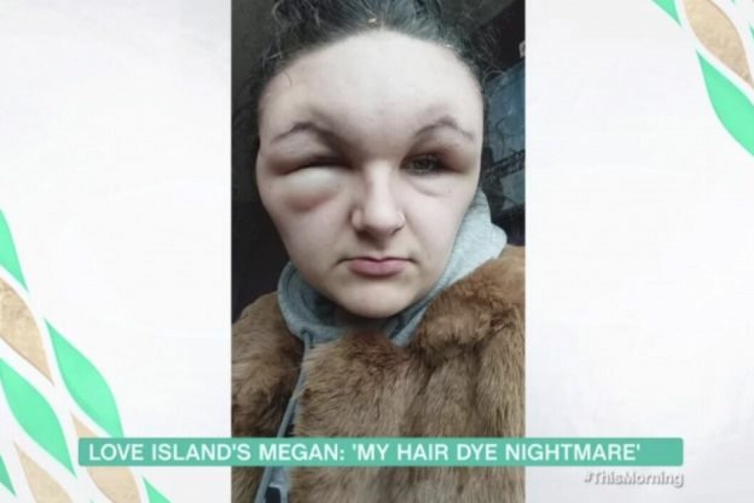 En av bilderna Megan tog som exempel på allergiska reaktioner man kan få av hårfärg.