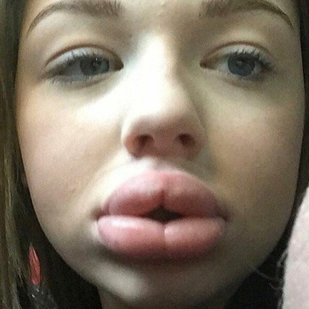 Fansen tar till drastiska metoder för att se ut som Kylie. Fansen tar till drastiska metoder för att se ut som Kylie.