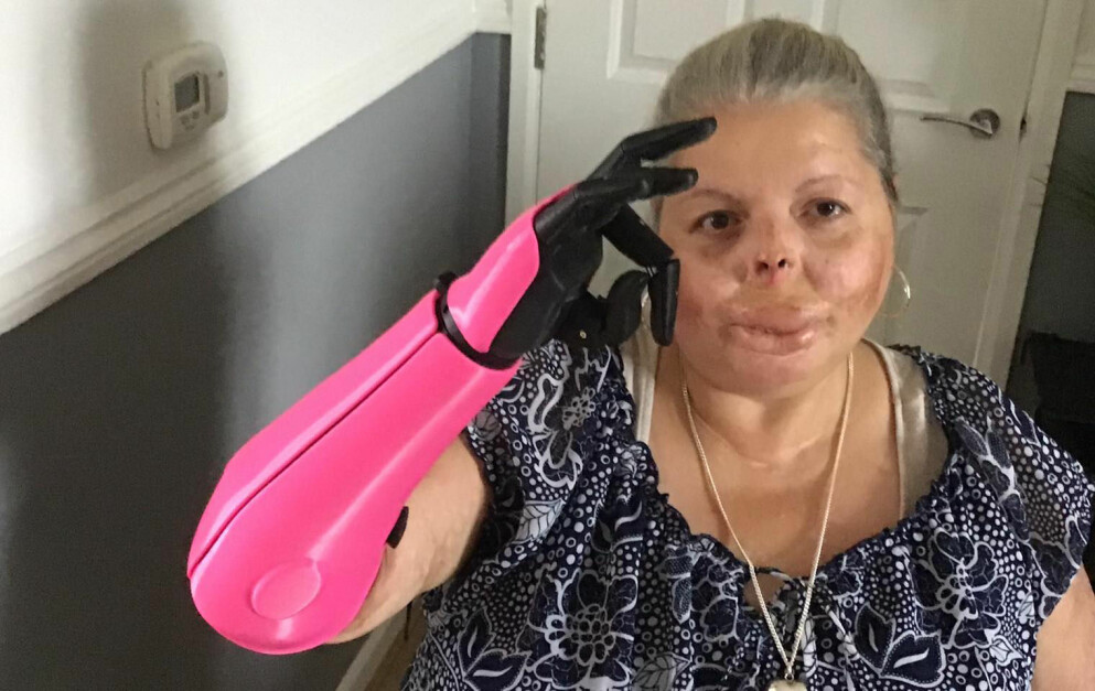 <strong>Susan Neil säger att hon gillar att armen inte försöker efterlikna en mänsklig arm utan har en robot-känsla över sig och sticker ut. I veckan ska hon ge sig in till byn och handla och hoppa att många berömmer hennes arm.</strong> Susan Neil säger att hon gillar att armen inte försöker efterlikna en mänsklig arm utan har en robot-känsla över sig och sticker ut.