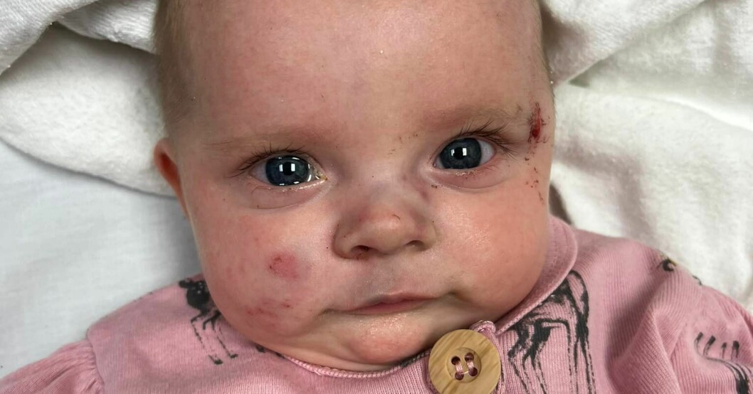 Familjen trodde att två månader gamla Oaklynn Charleigh Koon klarat sig utan några allvarligare skador. Men sen förvärrades tillståndet och hon hamnade i koma. Oaklynn Charleigh Koon