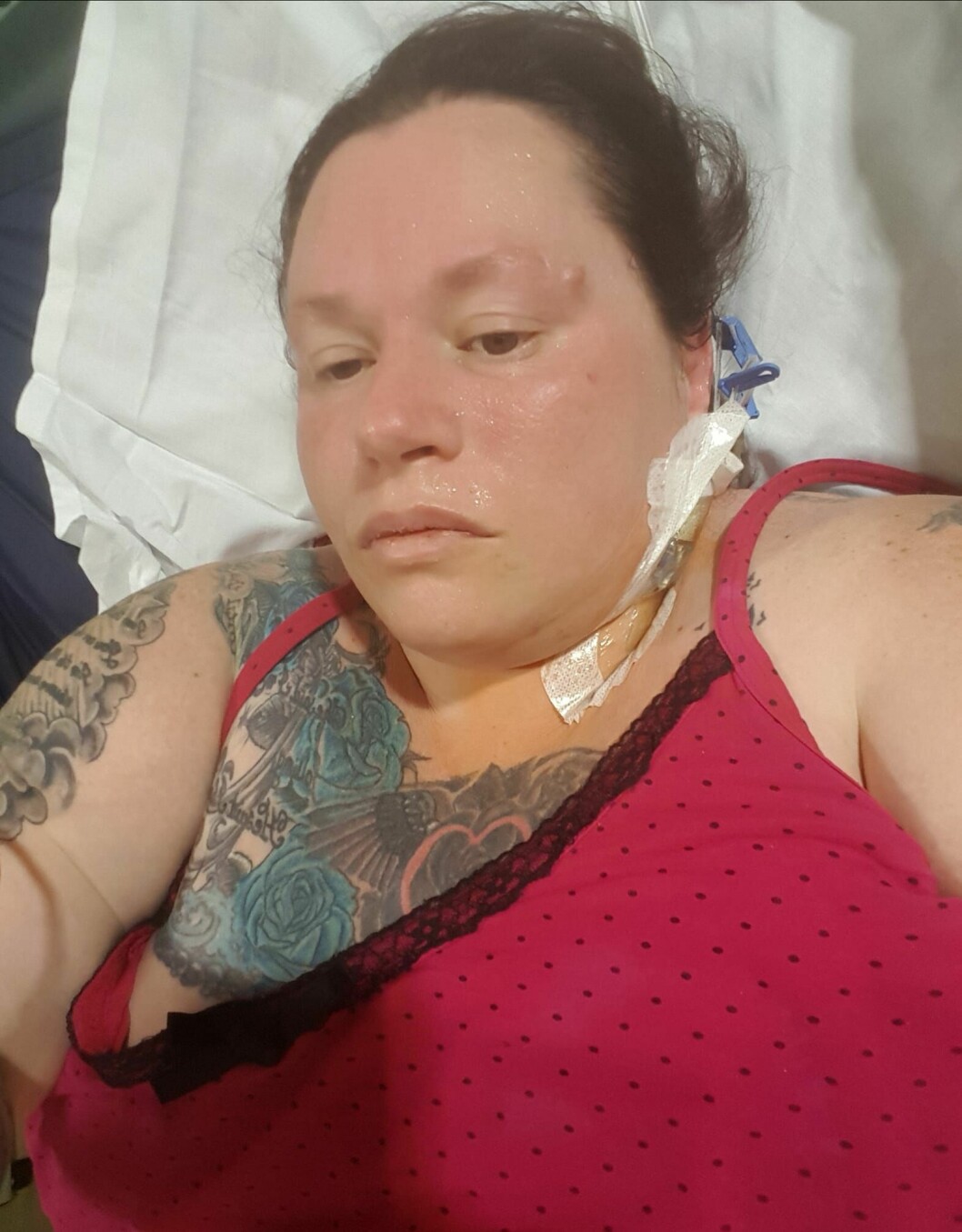 En köttätande bakterie hade kommit in i hennes operationssår. Bakterien sprider ett gift som gör att köttet runt bakterien börjar ”ruttna”. Samantha fick opereras flera gånger.