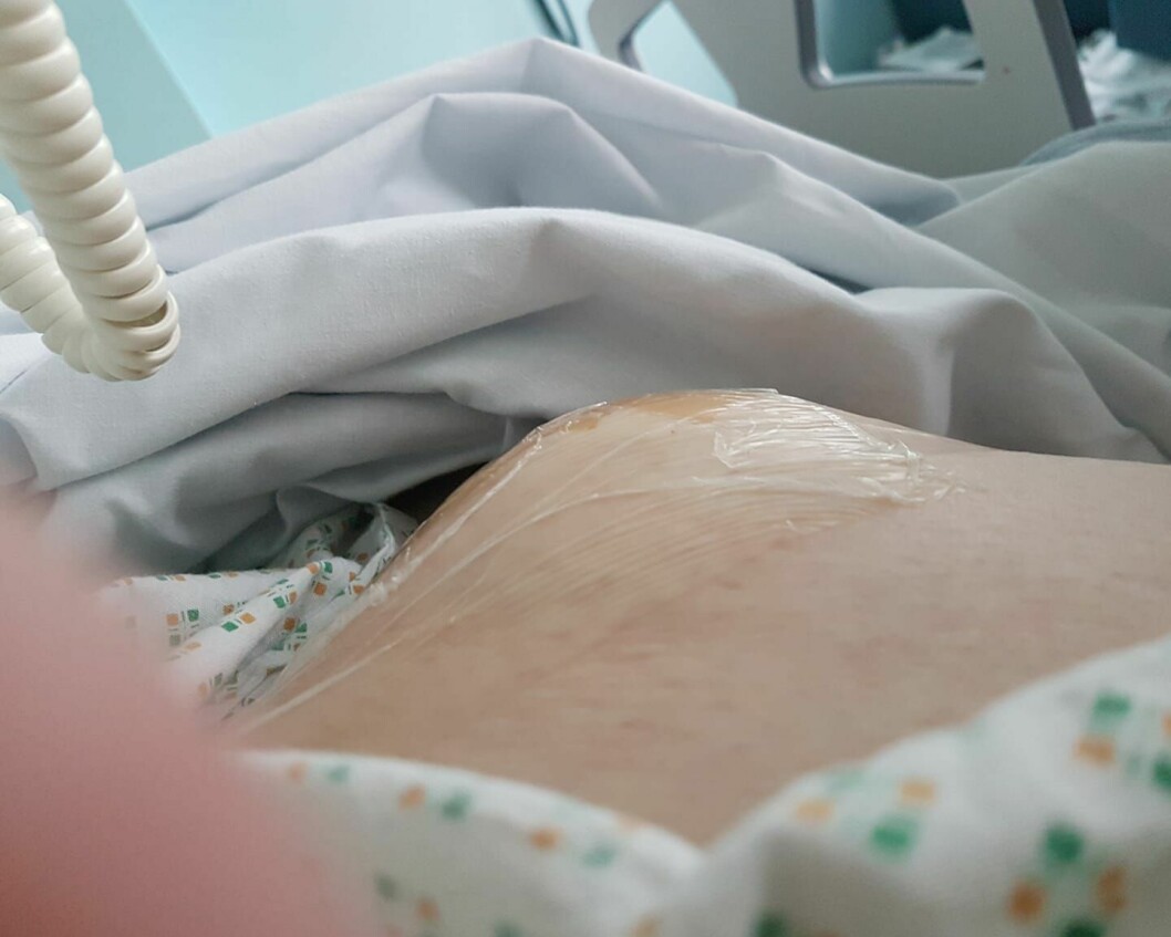 Ett bukbrock bildades 2018 på Samantha.