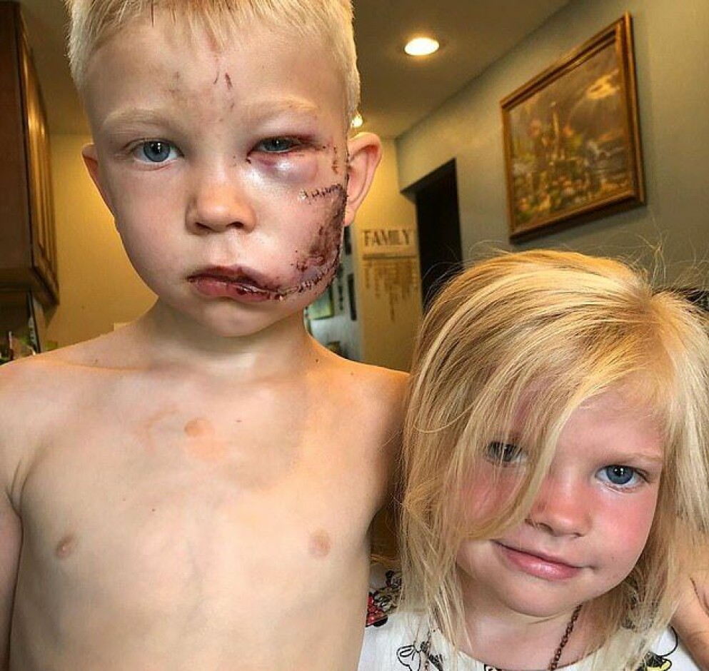 Bridger Walker med sin lillasyster, efter hund-attacken.
