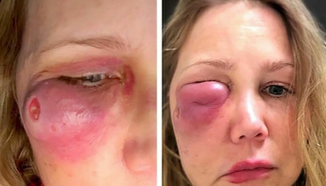 Efter fyra år svullnade Gina Andersons ansikte upp – och ett hål bildades rakt under hennes öga.