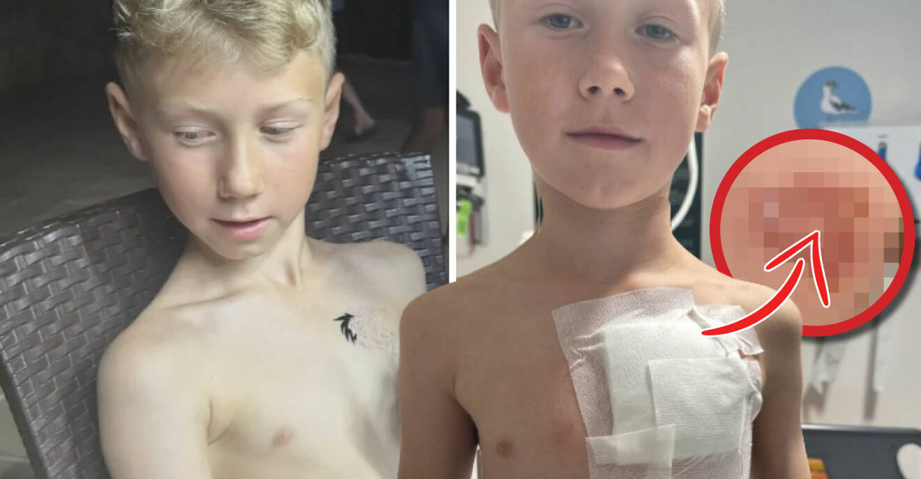 Ollie, 9, tatuerade sig på semestern – slutade i katastrof: ”Ärrad för livet”