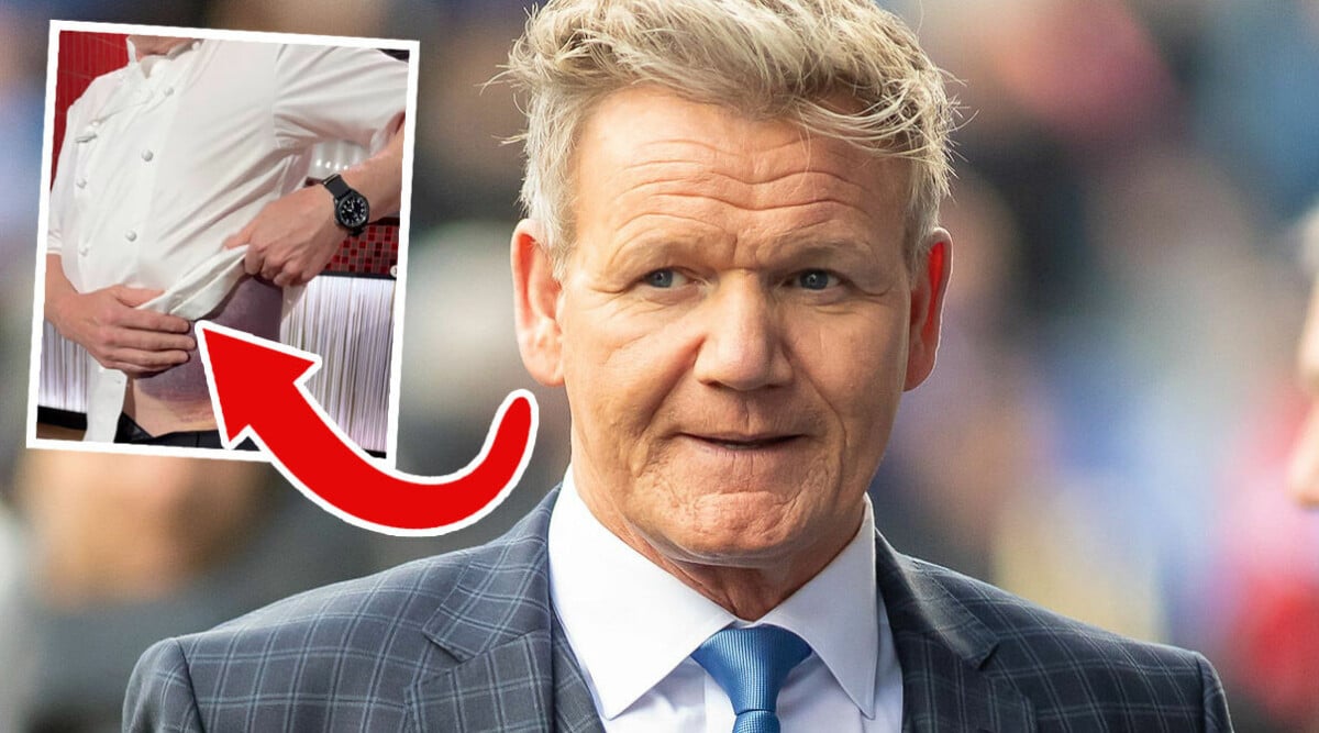 Nya skräckbilderna på Gordon Ramsey – spridit sig över hela magen