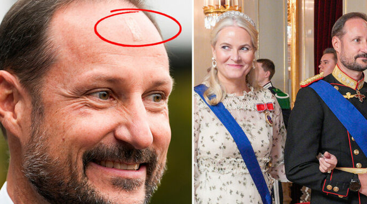 Stor oro för prins Haakon – plåster i ansiktet i månader ✔︎ Nu bekräftar hovet sanningen