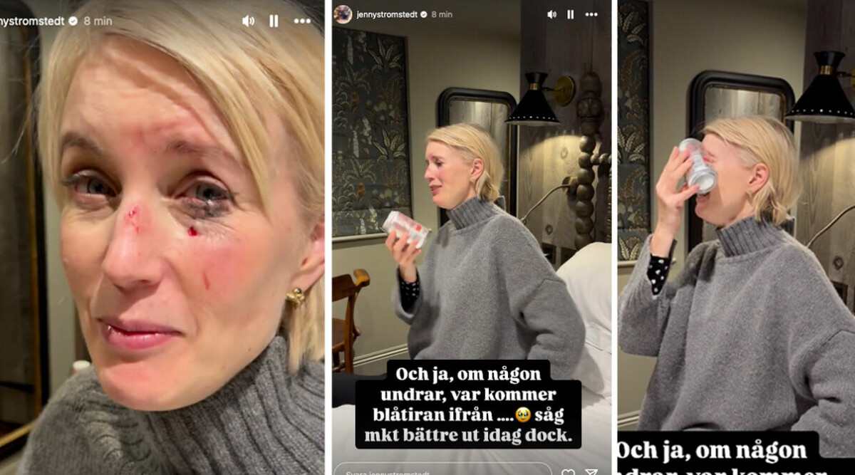 Jenny Strömstedt blåslagen – chockerande bilderna visar