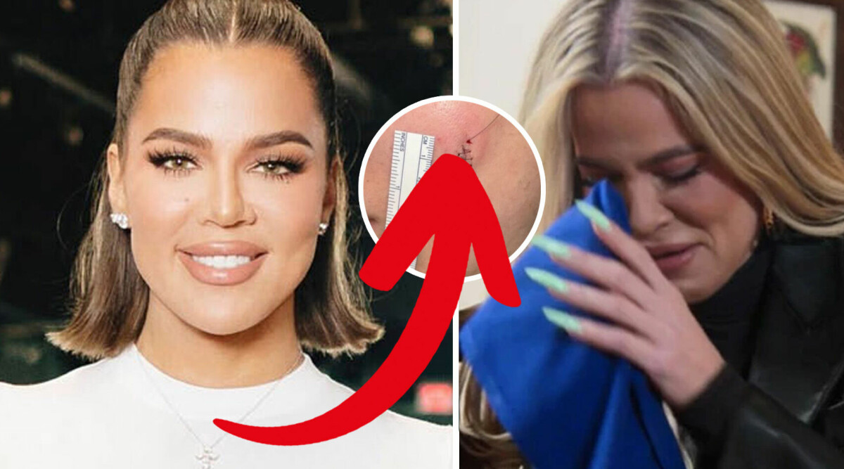 Skräckbilderna på Khloé Kardashian – tumör i ansiktet: ”Helt sjukt”