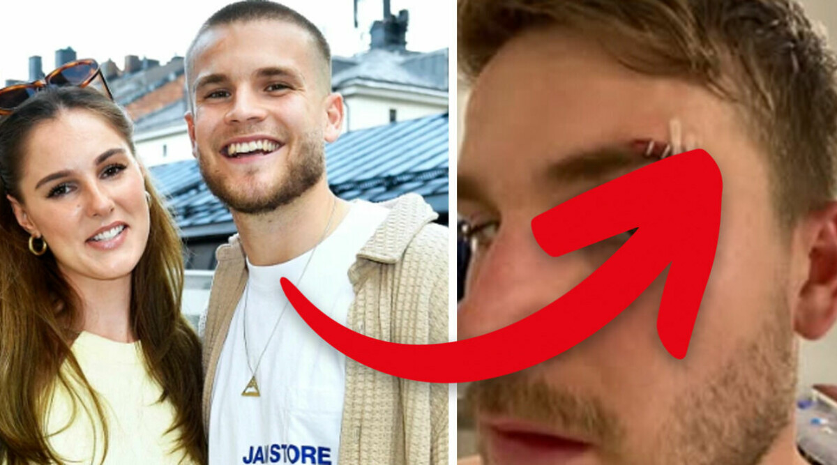 Amadeus Sögaard skadad i ansiktet inför bröllopet – vårdad av läkare