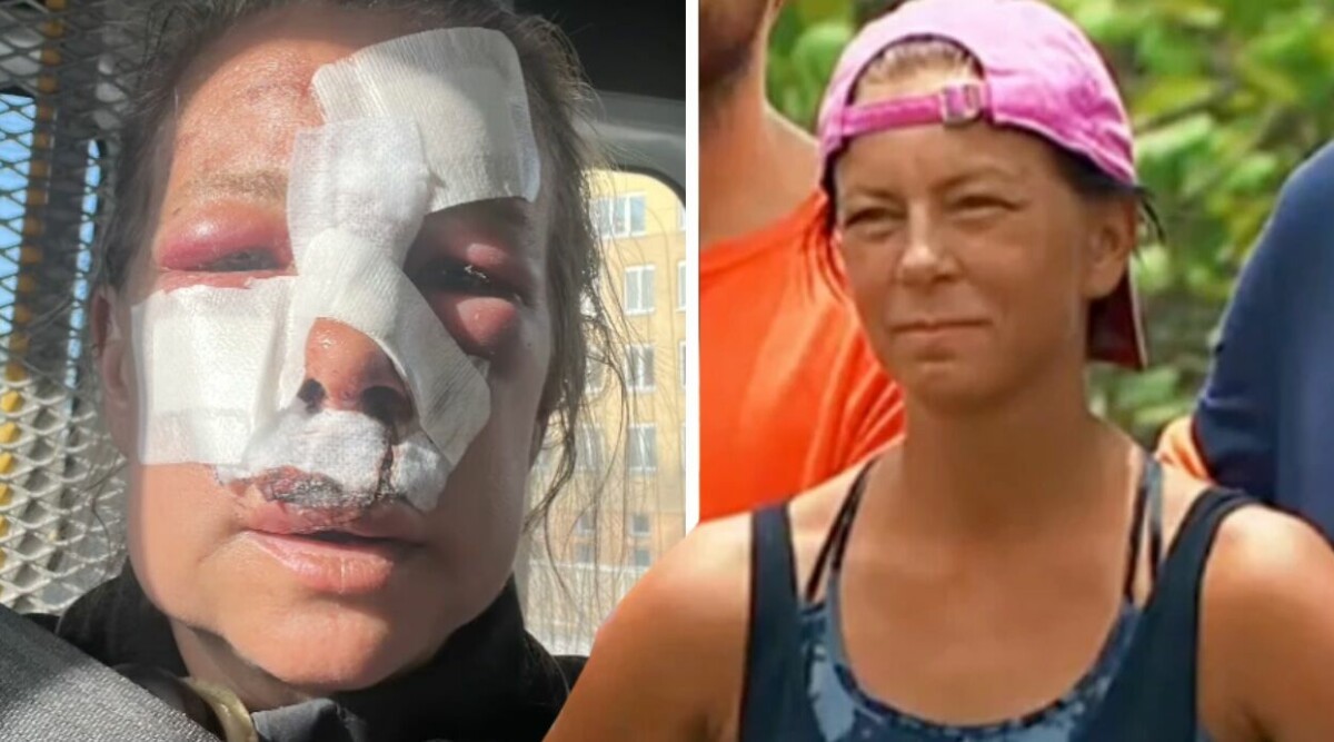 Robinson-deltagaren akut till sjukhus – allvarliga olyckan: ”Frakturer i ansiktet”
