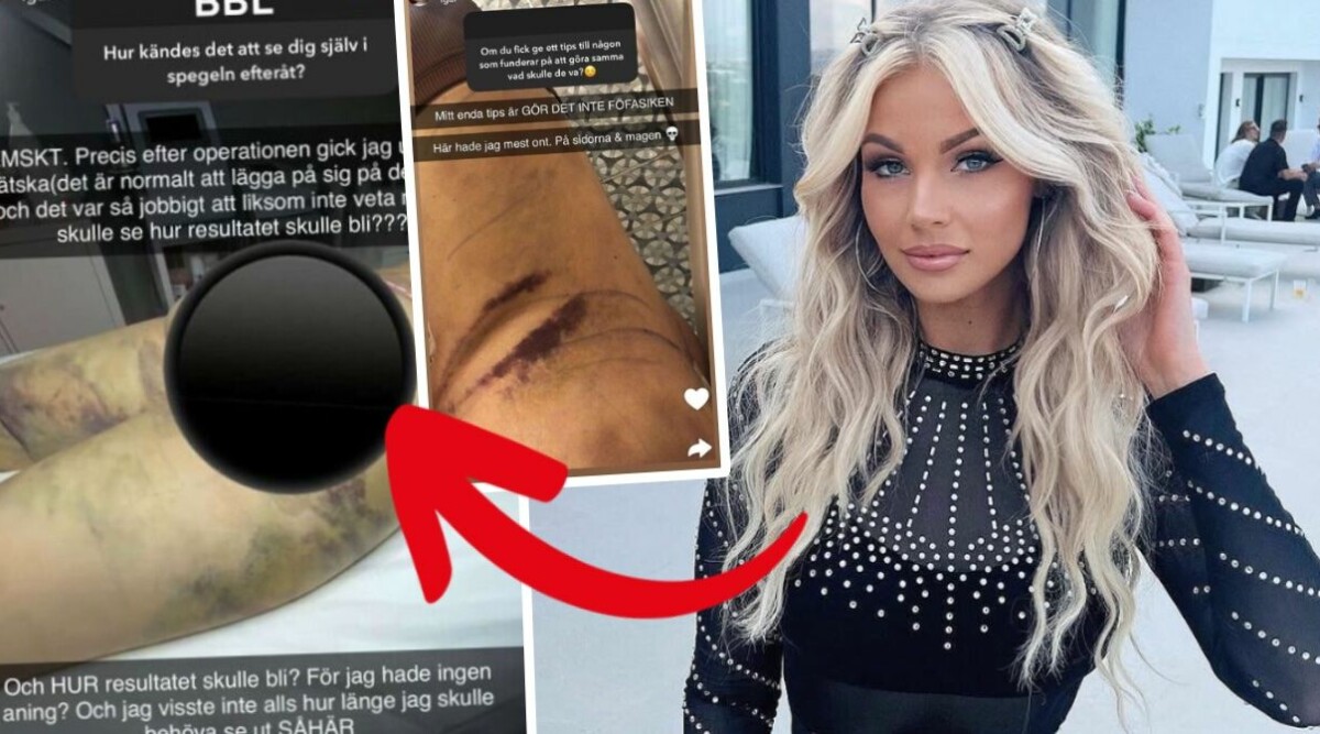 Svenska influencern varnar för livsfarliga operationen: ”Drog ut mina inälvor”