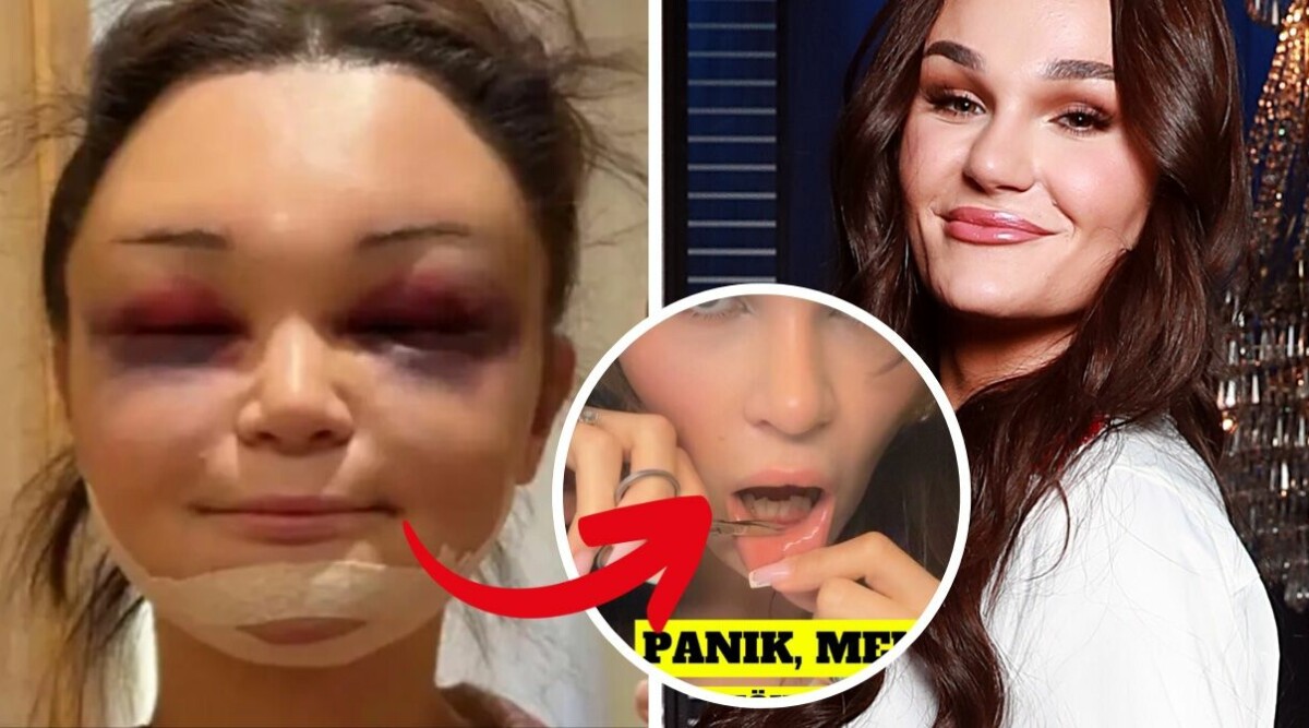 ”PANIK!” Tone Sekelius klipper sig i munnen – efter extrema operationen