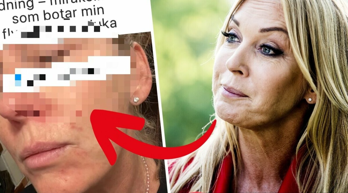 Linda Lindorffs ansikte förändrat – blir värre och värre: ”Skitjobbigt"