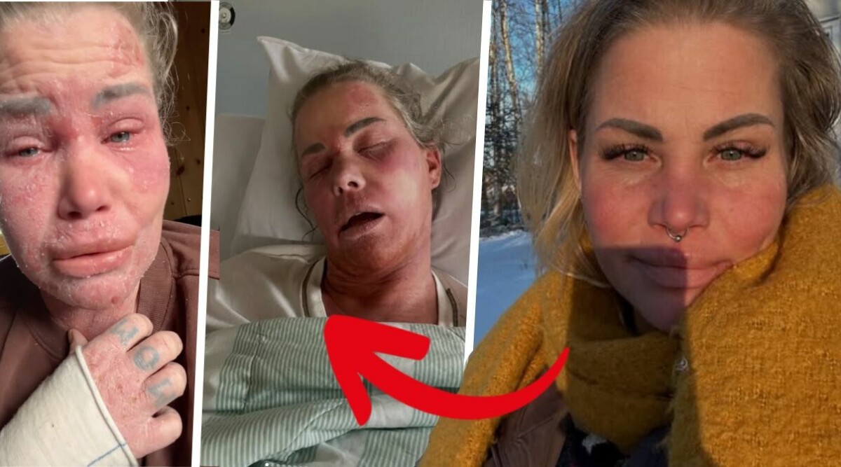 Svenska profilen akut till sjukhus – brännskadad över hela kroppen • Svåra smärtan