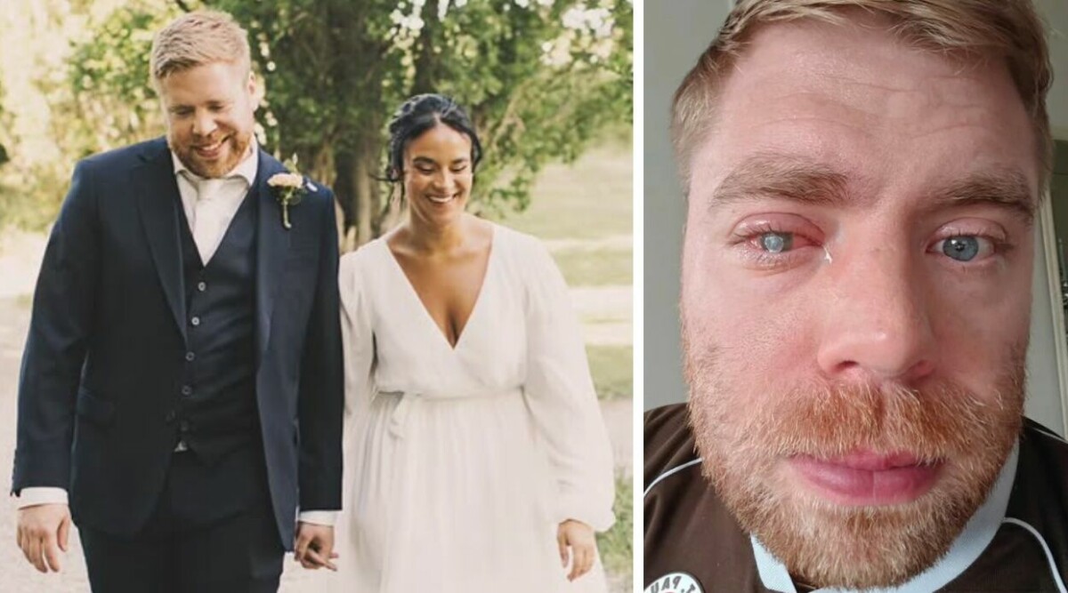 Läkarnas skräckbesked till 34-årige SVT-profilen – kan tvingas operera bort ögat