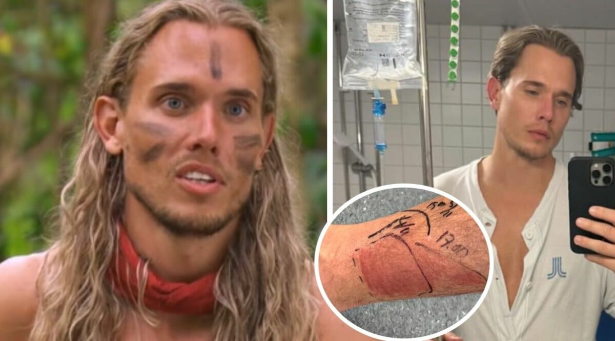 Robinson-deltagaren akut till sjukhus – oron för amputation: ”Hämtade mig i rullstol”