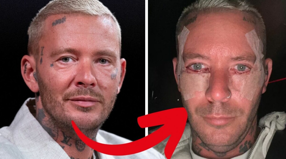 Joakim Lundell avslöjar skräckoperationen: ”Mina ögon hängde ner”