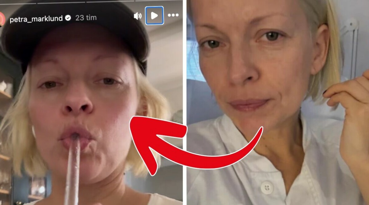 Petra Marklunds kamp efter operationen – får inte prata: ”Helt tyst i tre dagar”