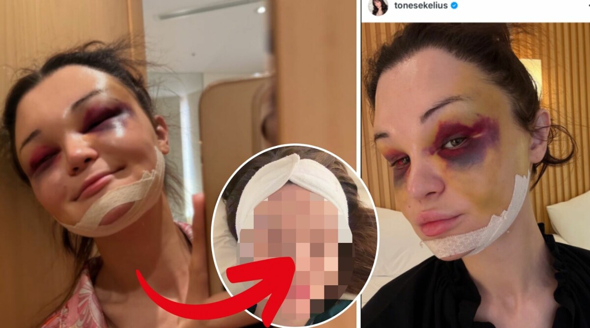 Efter intensiva ingreppet – så ser Tone Sekelius ut nu: ”Börjar äntligen känna igen mig själv”