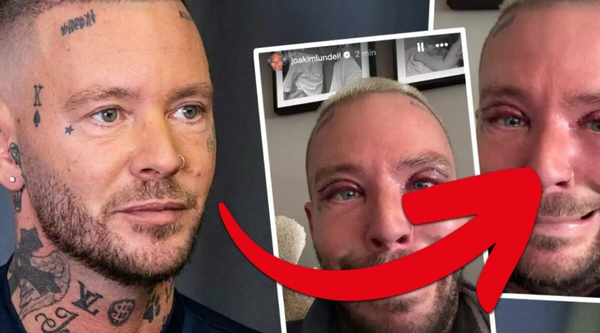 Joakim Lundells nya skönhetsoperation – så ser han ut nu