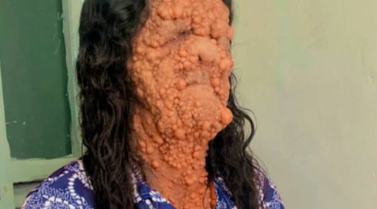 Influencern lider av ovanliga sjukdomen: ”Många tittar på mig med avsky”