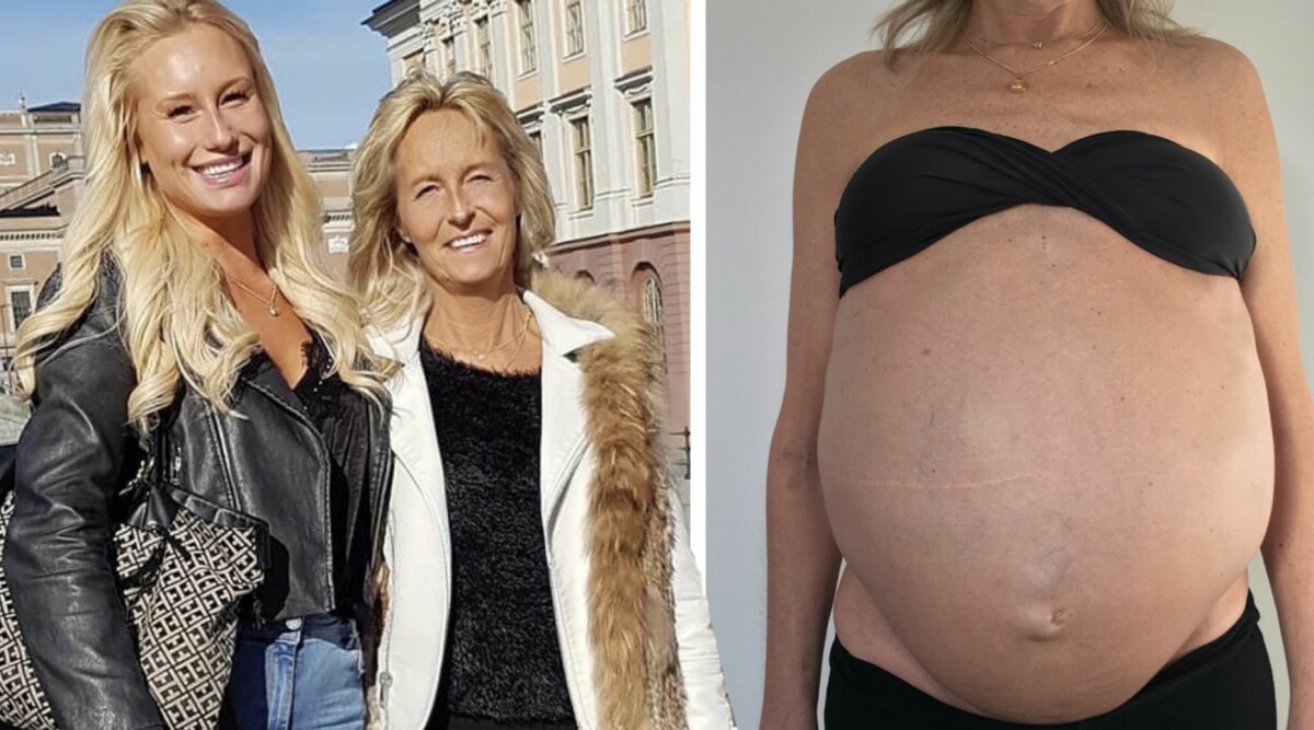 Camilla Fogestedt berättar om mamma Carinas ovanliga sjukdomskamp – levern vägde 15 kilo