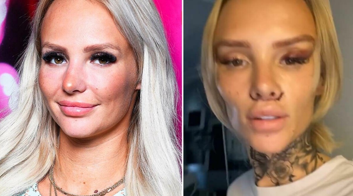 Paulina ”Paow” Danielsson visar upp resultatet efter läpplyftet