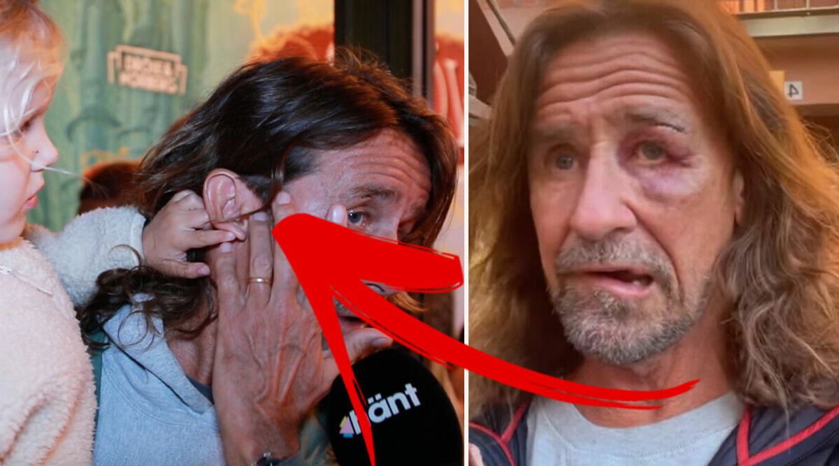 Anders Timell visar upp ansiktet efter otäcka skadan – nya bilden visar