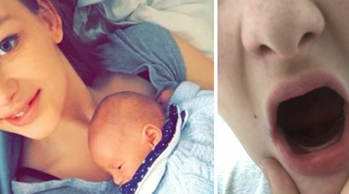 Louise, 26, tappade alla sina tänder som gravid – är ytterst ovanligt