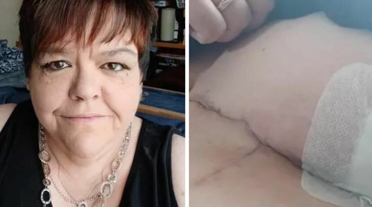 Sylvia fick skavsår av bh:n – slutade med att hon kämpade för sitt liv