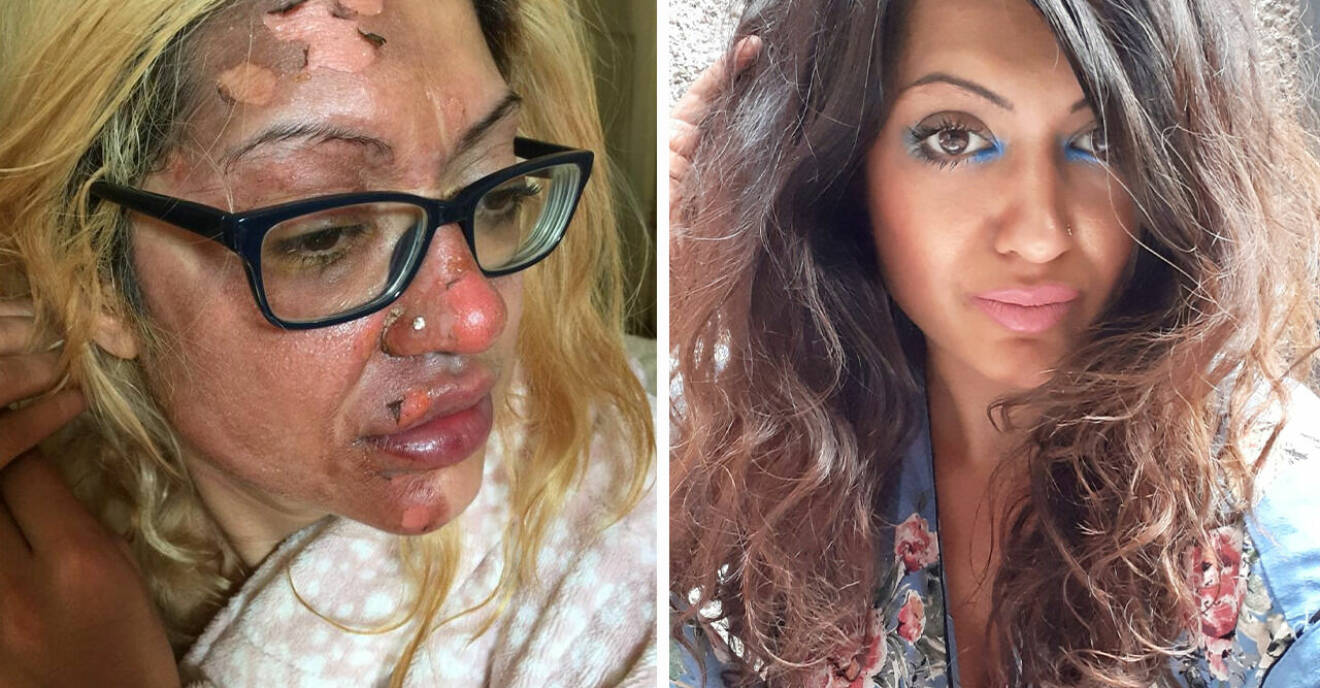 37-åriga mamman Shafia råkade ut för äggsplosion: ”Värsta smärtan i mitt liv”