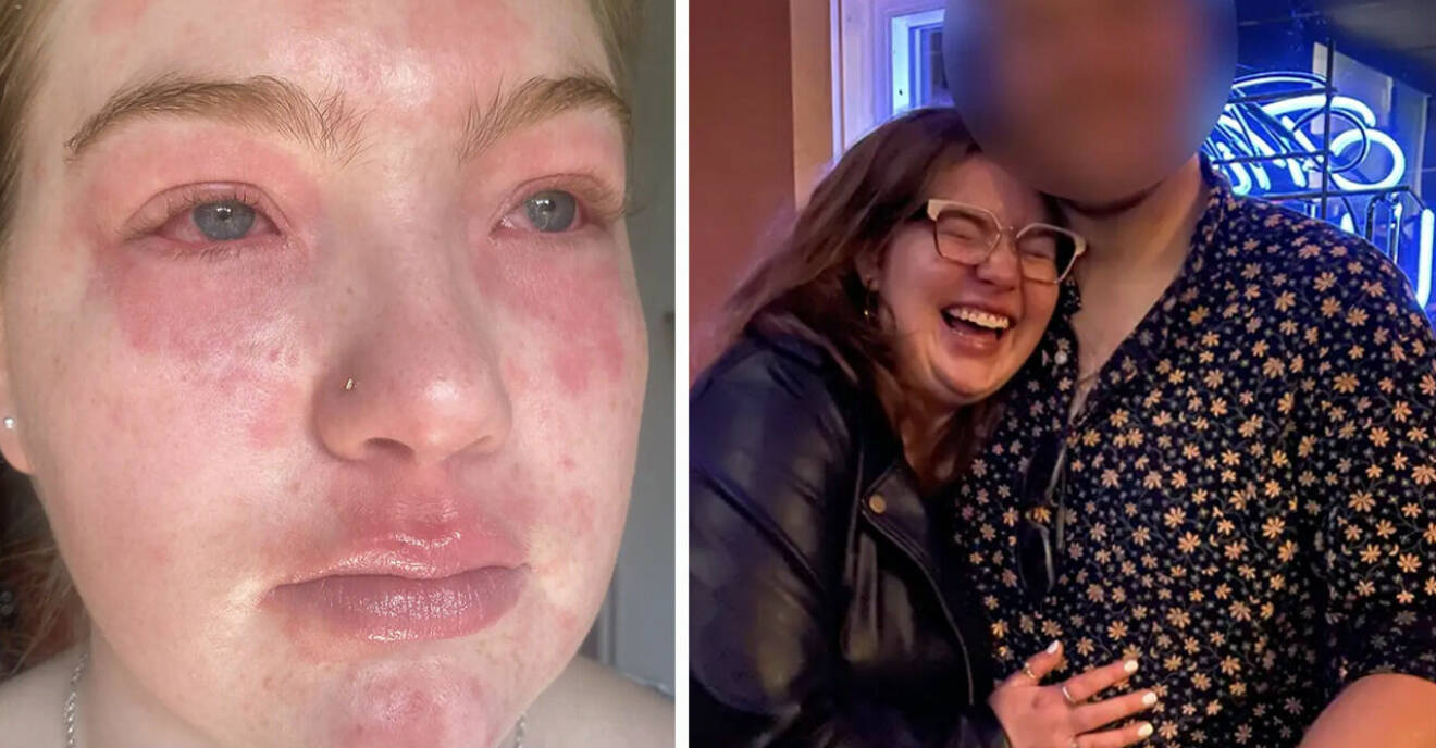 22-åriga Virginia är allergisk mot sin pojkvän – får röda utslag när de ses.