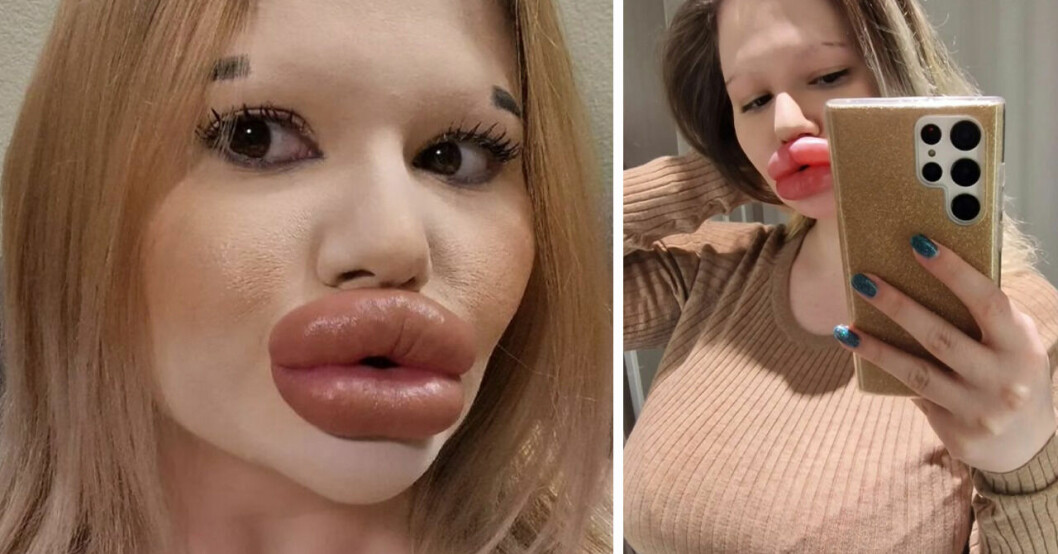 Andrea, 25, kan inte få en pojkvän – på grund av sina läppar.