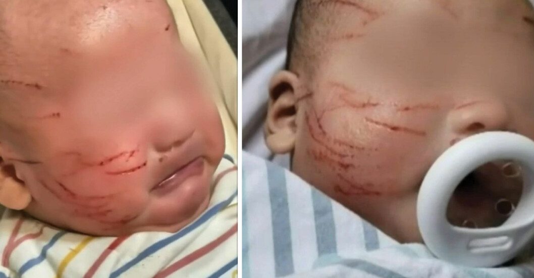 10-veckor gamla Noah attackerad – på förskolan: ”Blodiga sår…”