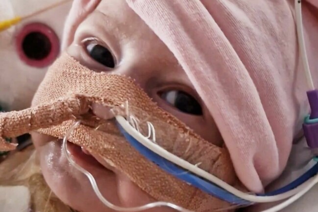 Den 13 juni genomfördes den livsnödvändiga operationen på Royal Brompton Hospital i London. Det tog elva timmar att göra ingreppet i Dorotheas hjärta. Dorothea med sladdar i näsan.