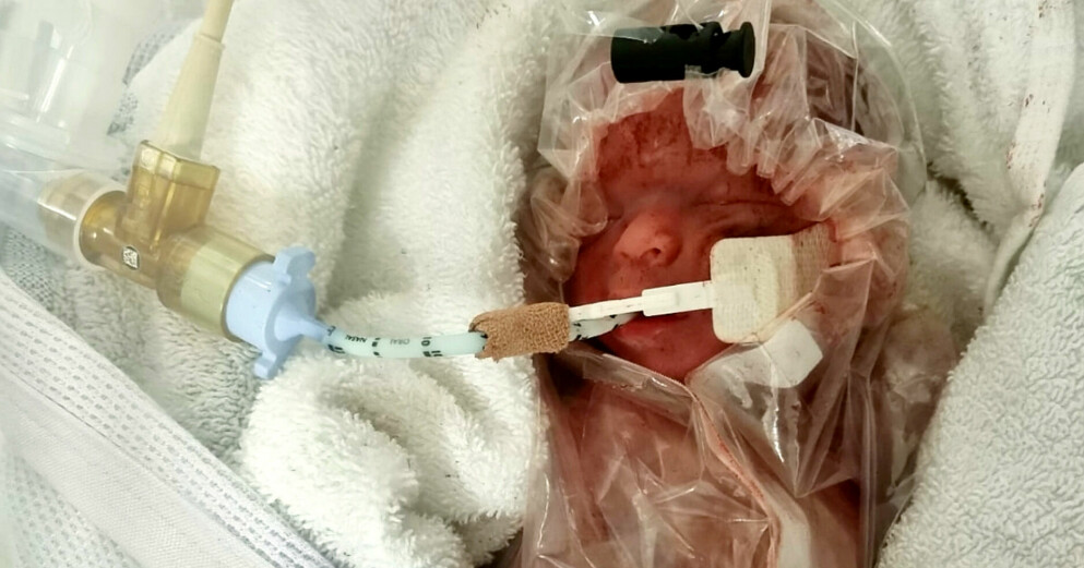 Pace Galbraith vägde bara 560 gram vid födseln och fick läggas i en plastpåse. Pace Galbraith
