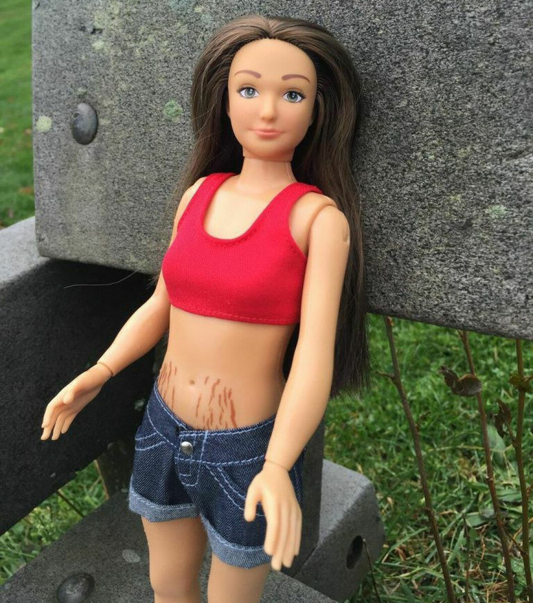 Via: <a href="http://www.buzzfeed.com/alisonvingiano/this-normal-barbie-comes-with-cellulite-stretch-marks-acne-a">BuzzFeed</a> barbieBristningar