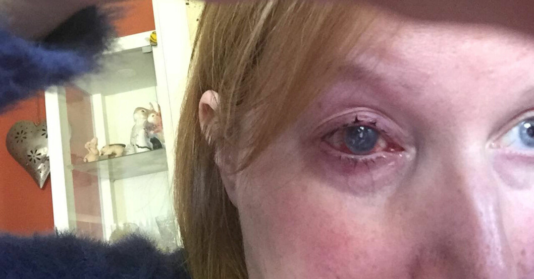 Marie tvingades operera bort ögat – på grund av kontaktlinserna