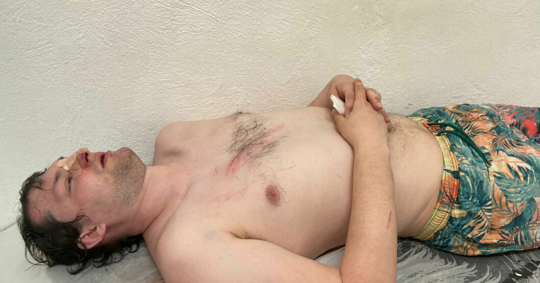 James åkte in med ansiktet i en trappa och bröt näsan. Han fick också stora sår på bröstet. James åkte in med ansiktet i en trappa och bröt näsan. Han fick också stora sår på bröstet.