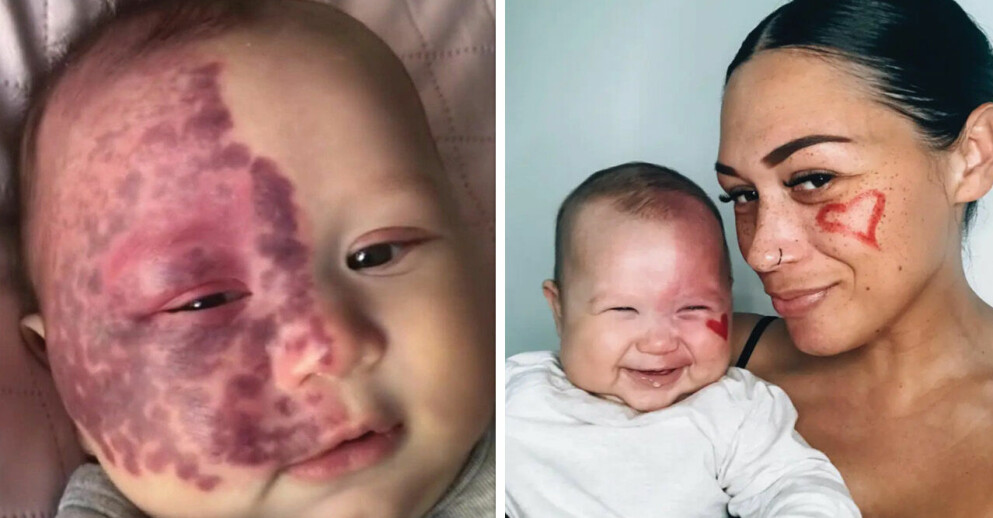 33-åriga mamma Brooke Atkins blir kallad för ”monster”, efter att hennes 6-månader gamla son genomgått en laserbehandling