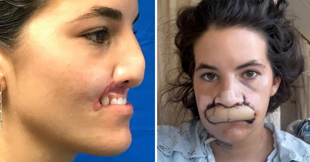 Brooklinn, 23, attackerades av en hund och fick överläppen bortsliten