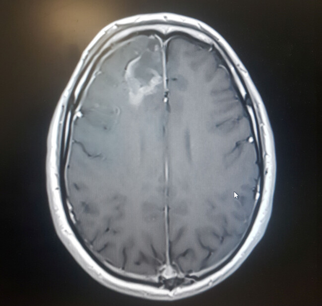 Röntgenbild på Kevins hjärntumör.