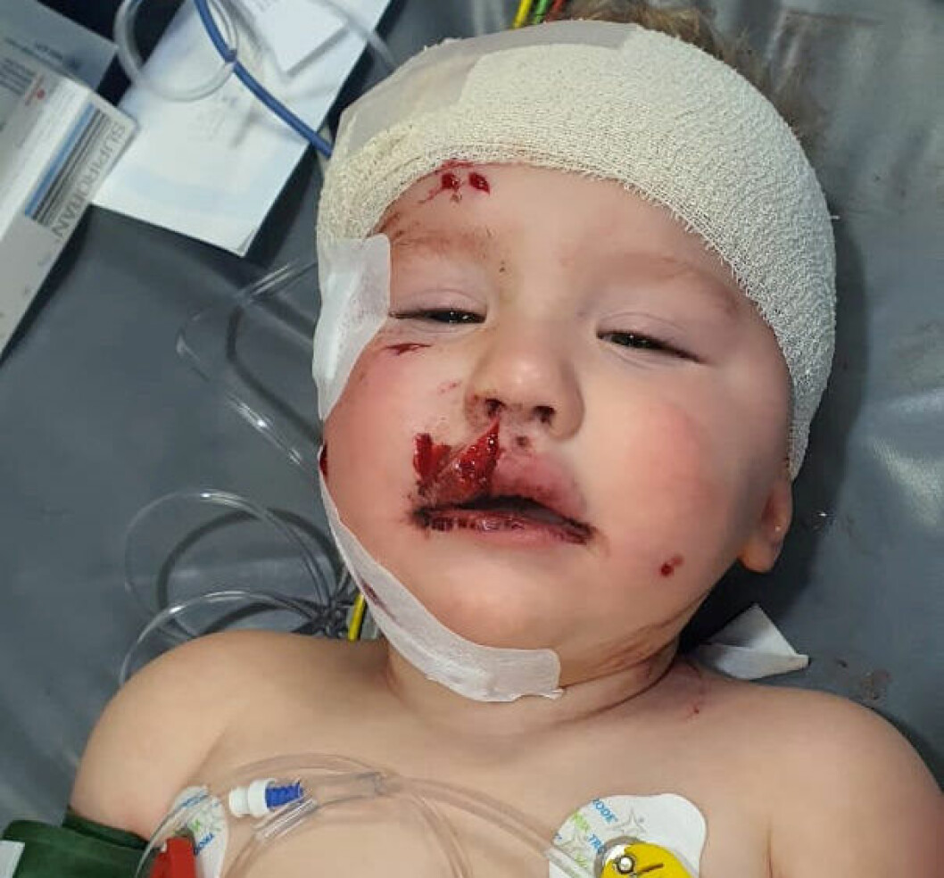 Medé, 1 år, attackerades av familjens hund.