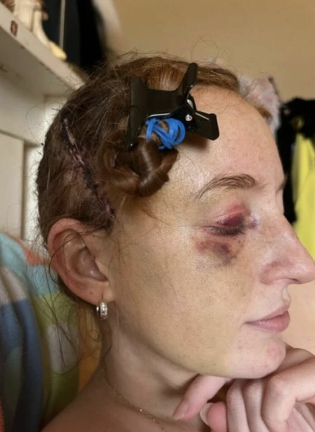 Efter mycket om och men – så hittade vårdpersonalen en enorm tumör i Claudias hjärna.