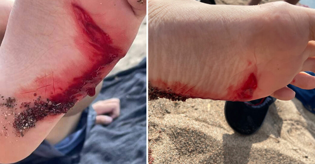 På stranden fick Mathias hjälp av en undersköterska som tvättade rent såret.