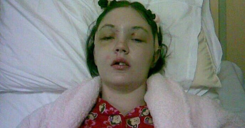 Grianne Kealy efter första operationen. Grianne Kelly