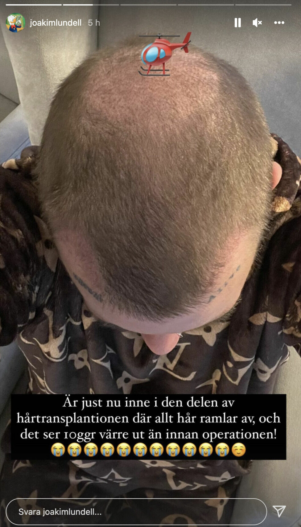 Här visar Joakim upp de kala fläckarna där hårsäckar transplanterats in under huden på hjässan. Här visar Joakim upp de kala fläckarna där hårsäckar transplanterats in under huden på hjässan.